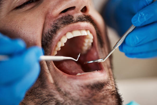 Best Emergency Treatment for Dental Infections or Abscesses in Half Moon Bay, CA